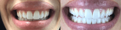 Case 7586 - 45-54 year old woman treated with Zoom Whitening