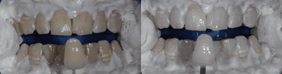 Case 7587 - 18-24 year old man treated with Zoom Whitening