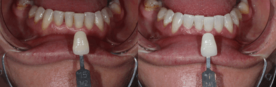 Case 7588 - 25-34 year old man treated with Zoom Whitening