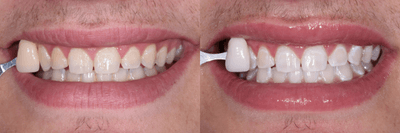 Case 7589 - ZOOM! In-Office Teeth Whitening