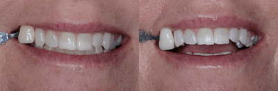 Case 7590 - ZOOM! In-Office Whitening Treatment