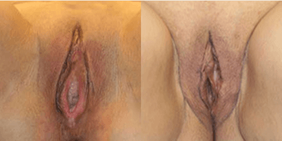 Case 7671 - Woman treated with Vaginoplasty