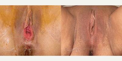 Case 7672 - 45 year old woman treated with Vaginoplasty