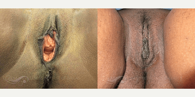 Case 7674 - 53 year old woman treated with Vaginoplasty