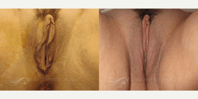 Case 7675 - 40 year old woman treated with Vaginoplasty