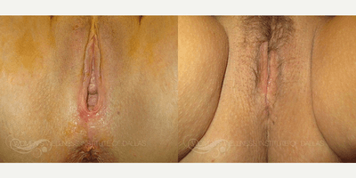 Case 7677 - 53 year old woman treated with Vaginoplasty