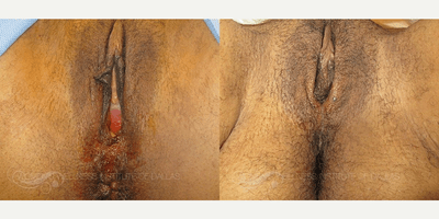 Case 7678 - 53 year old woman treated with Vaginoplasty