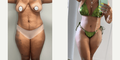 Case 77 - Woman treated with Tummy Tuck