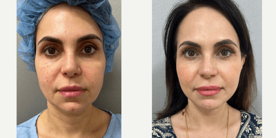 Case 7863 - 45-54 year old woman treated with Facelift
