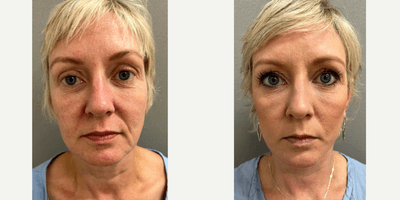 Case 7877 - 48 year old woman treated with NaturalLift, Neck Lift