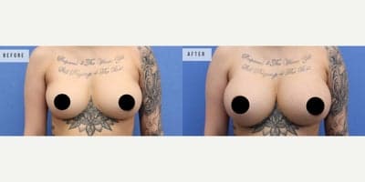 Case 7912 - Woman treated with Breast Augmentation, Breast Implants