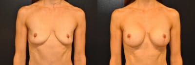 Case 7913 - Woman treated with Breast Augmentation, Breast Implants