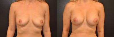 Case 7914 - Woman treated with Breast Augmentation, Breast Implants