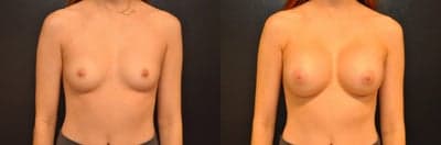 Case 7915 - Woman treated with Breast Augmentation, Breast Implants