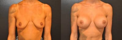 Case 7916 - Woman treated with Breast Augmentation, Breast Implants