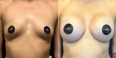 Case 7917 - Woman treated with Breast Augmentation, Breast Implants