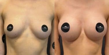Case 7918 - Woman treated with Breast Augmentation, Breast Implants