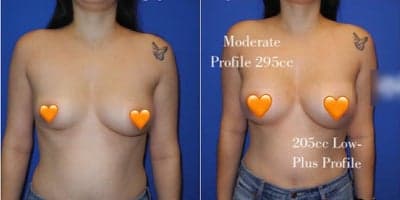 Case 7919 - Woman treated with Breast Augmentation, Breast Implants