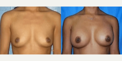 Case 7977 - Woman treated with Breast Augmentation