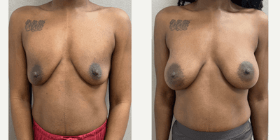 Case 8023 - 35-44 year old woman treated with Breast Augmentation