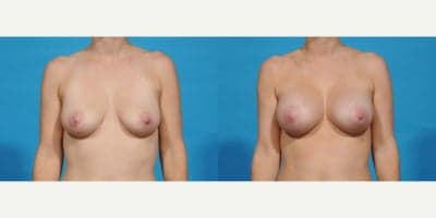 Case 8031 - 25-34 year old woman treated with Breast Implants, Breast Augmentation, Inspira Breast Implants, Natrelle Breast Implants