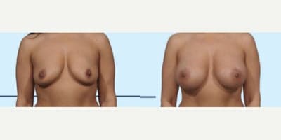 Case 8034 - Woman treated with Breast Implants