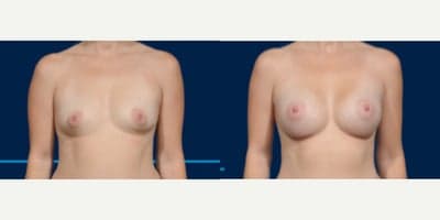 Case 8035 - Woman treated with Breast Implants