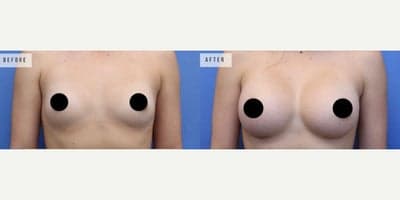 Case 8036 - Woman treated with Breast Augmentation, Breast Implants