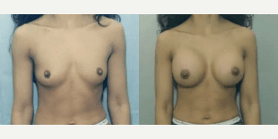 Case 8057 - Woman treated with Breast Implants