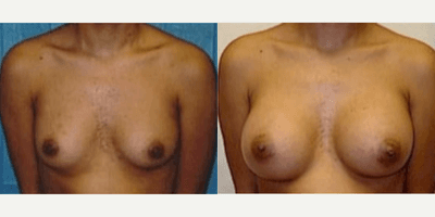 Case 8103 - Woman treated with Breast Implants