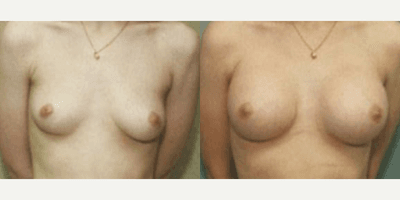 Case 8104 - Woman treated with Breast Implants
