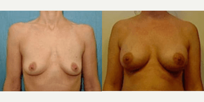 Case 8105 - Woman treated with Breast Implants
