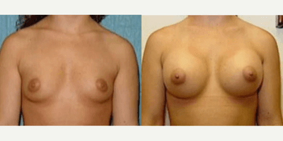 Case 8106 - Woman treated with Breast Implants