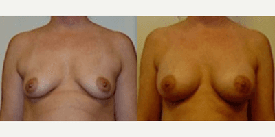 Case 8137 - Woman treated with Breast Implants