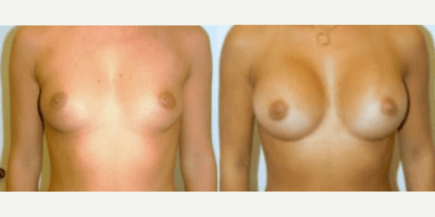 Case 8138 - Woman treated with Breast Implants
