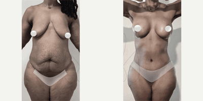 Case 8140 - Woman treated with Breast Implants
