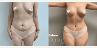 Case 8141 - Woman treated with Breast Implants