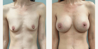 Case 8149 - 35-44 year old woman treated with Breast Augmentation, Breast Implants