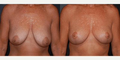 Case 8151 - Woman treated with Breast Lift, Breast Reduction