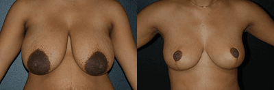 Case 8152 - Woman treated with Breast Lift, Breast Reduction