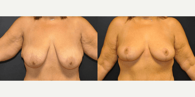 Case 8153 - Woman treated with Breast Lift, Breast Reduction