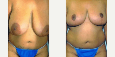 Case 8155 - Woman treated with Breast Reduction