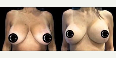 Case 8271 - Woman treated with Breast Lift, Breast Implant Revision