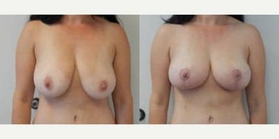 Case 8272 - Woman treated with Breast Lift