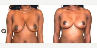 Case 8274 - Woman treated with Breast Lift