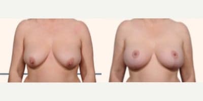 Case 8277 - Woman treated with Breast Lift