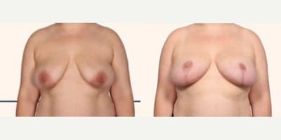 Case 8278 - Woman treated with Breast Lift