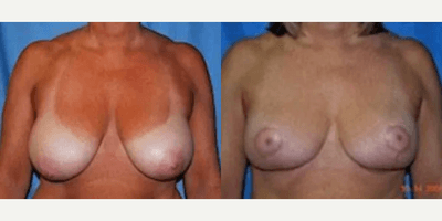 Case 8297 - Woman treated with Breast Lift