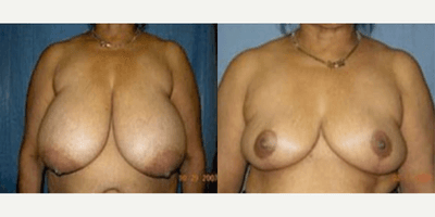 Case 8312 - Woman treated with Breast Lift