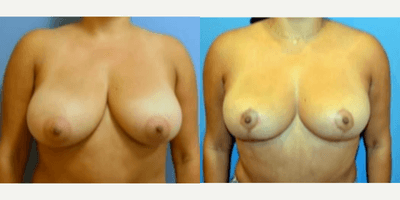 Case 8323 - Woman treated with Breast Lift